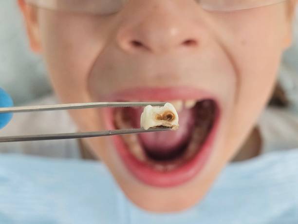 Best Emergency Wisdom Teeth Removal in West Mayfield, PA